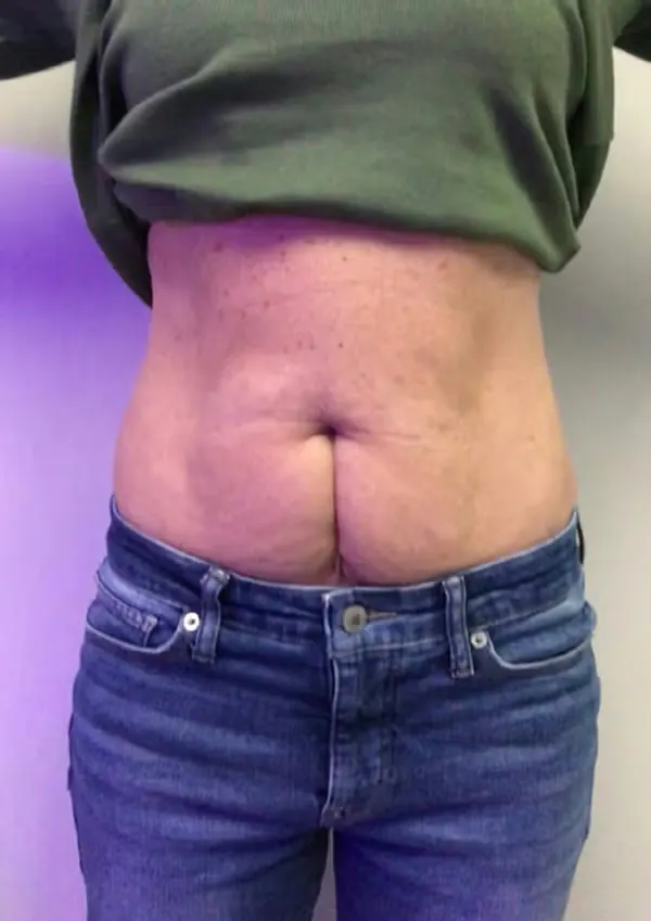 Before treatment
