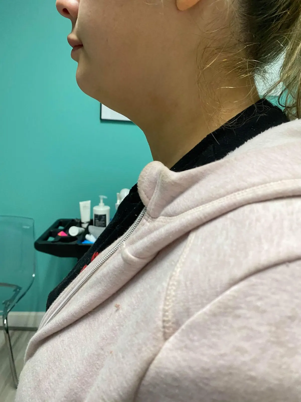 Before treatment