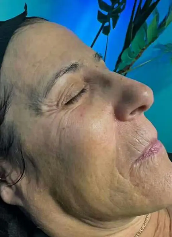 Before treatment
